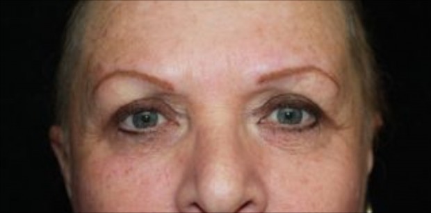 Brows - Pre Chemotherapy 2 after
