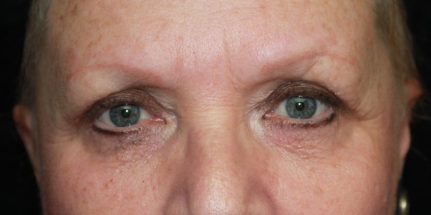 Brows - Pre Chemotherapy 2 before