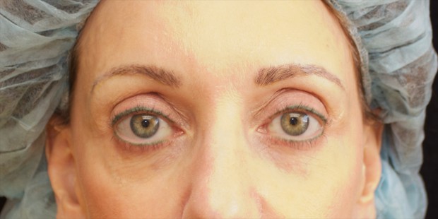 Color corrected Brows- Virgin Skin 8 before