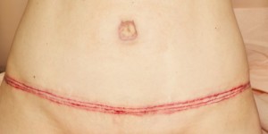 Needling for a Tummy Tuck Scar after
