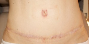 Needling for a Tummy Tuck Scar healed
