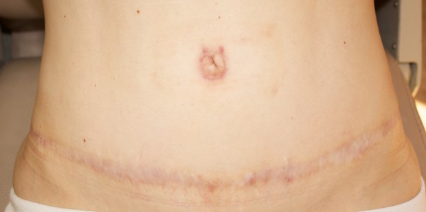 Needling for a Tummy Tuck Scar healed