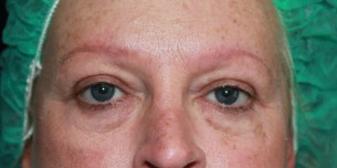 brows- corrective tattooing 4 before