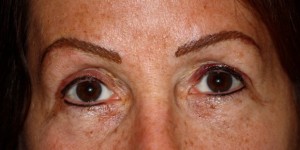 brows- pre chemotherapy 1 after