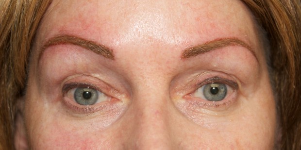 brows- pre chemotherapy 3 after
