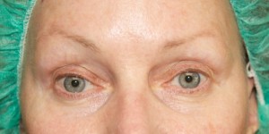brows- pre chemotherapy 3 before