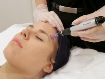 skin needling image by elise affordable scar removal in newport beach