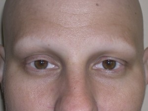 Alopecia - Before