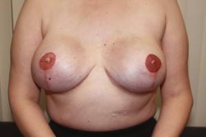 nipple/areola complex procedure