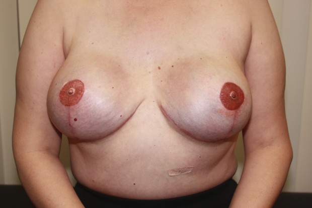 nipple/areola complex procedure