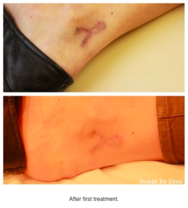 quick tattoo removal in newport beach image by elise